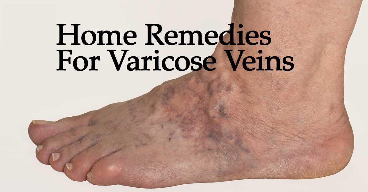 varicose veins home remedies